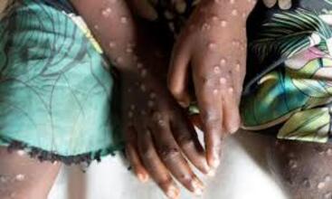 Kenya: le nombre de cas de Mpox s’élève à 7